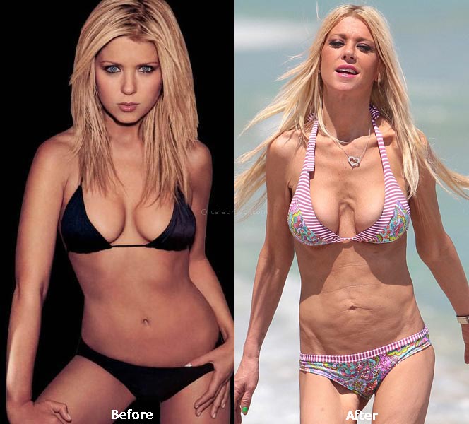 Tara Reid plastic surgery before and after