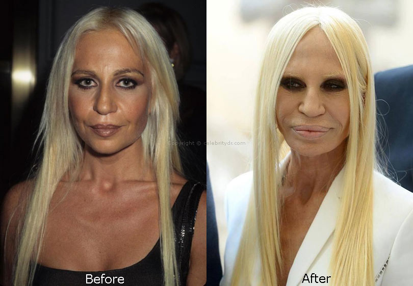 Donatella Versace plastic surgery before and after