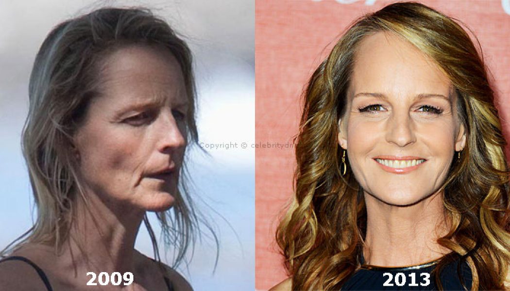 Helen Hunt before and after plastic surgery