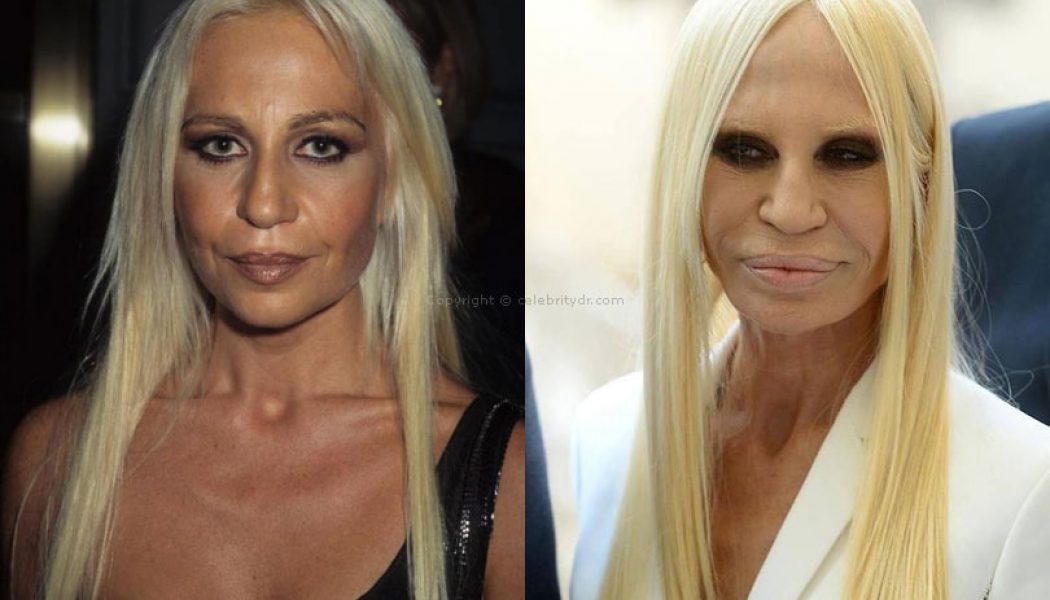 Donatella Versace plastic surgery before and after